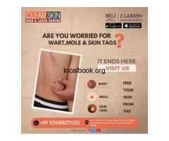 Best Acne Scar Laser Treatment  In India